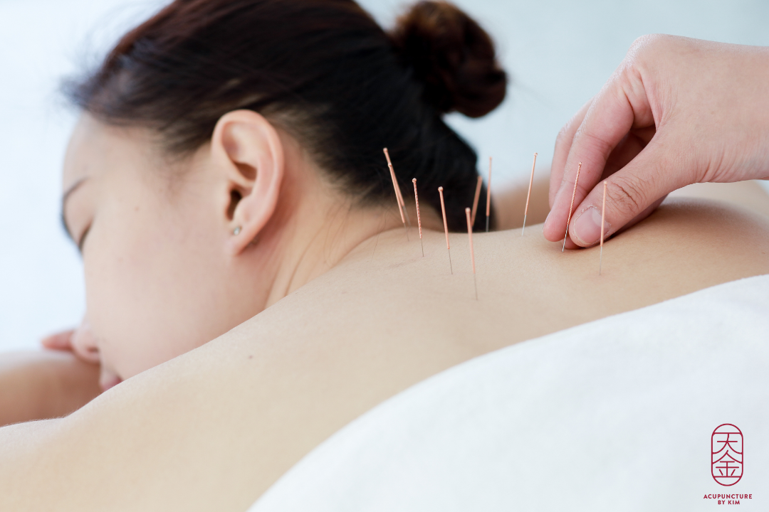 Acupuncture by Kim, Jan Schaeferbrug, Amsterdam
