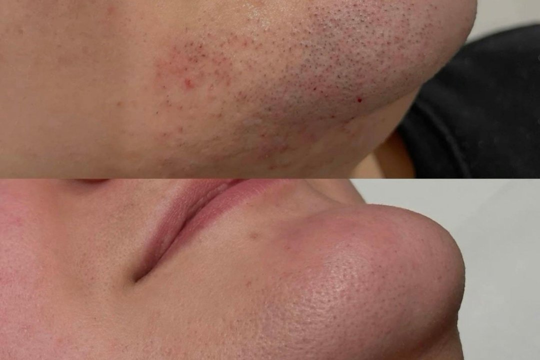 Lumea by haar-atelier Lepore, Alt-Tegel, Berlin