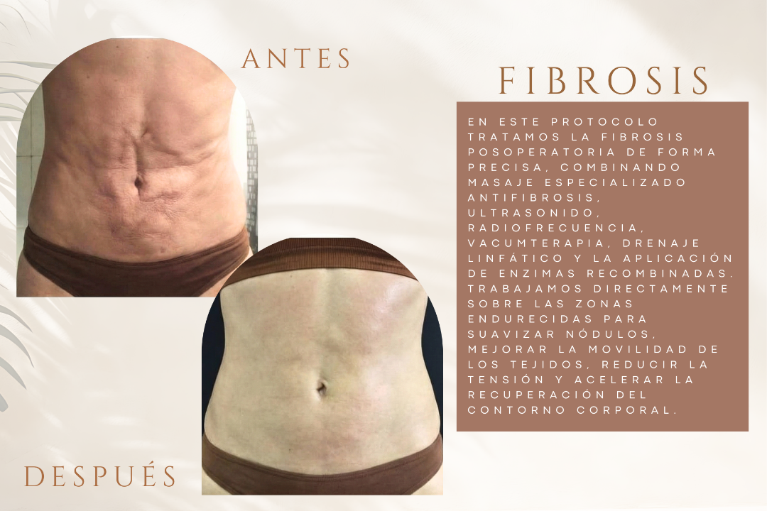 Modele Estética | Especialistas en Moldeo corporal, Fibrosis, Posoperatorio y Celulitis en Valencia, Nou Moles, Valencia