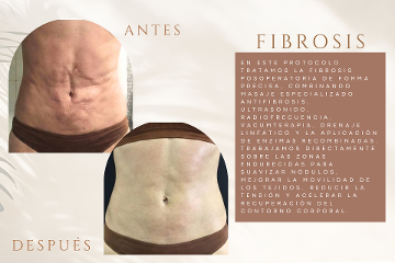 Modele Estética | Especialistas en Moldeo corporal, Fibrosis, Posoperatorio y Celulitis en Valencia
