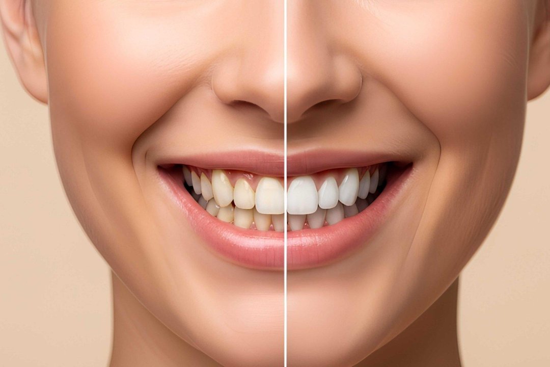 Beauty Spell - Dauerhafte Haarentfernung - Bodyforming - Zahnbleaching in Ludwigshafen, Ludwigshafen