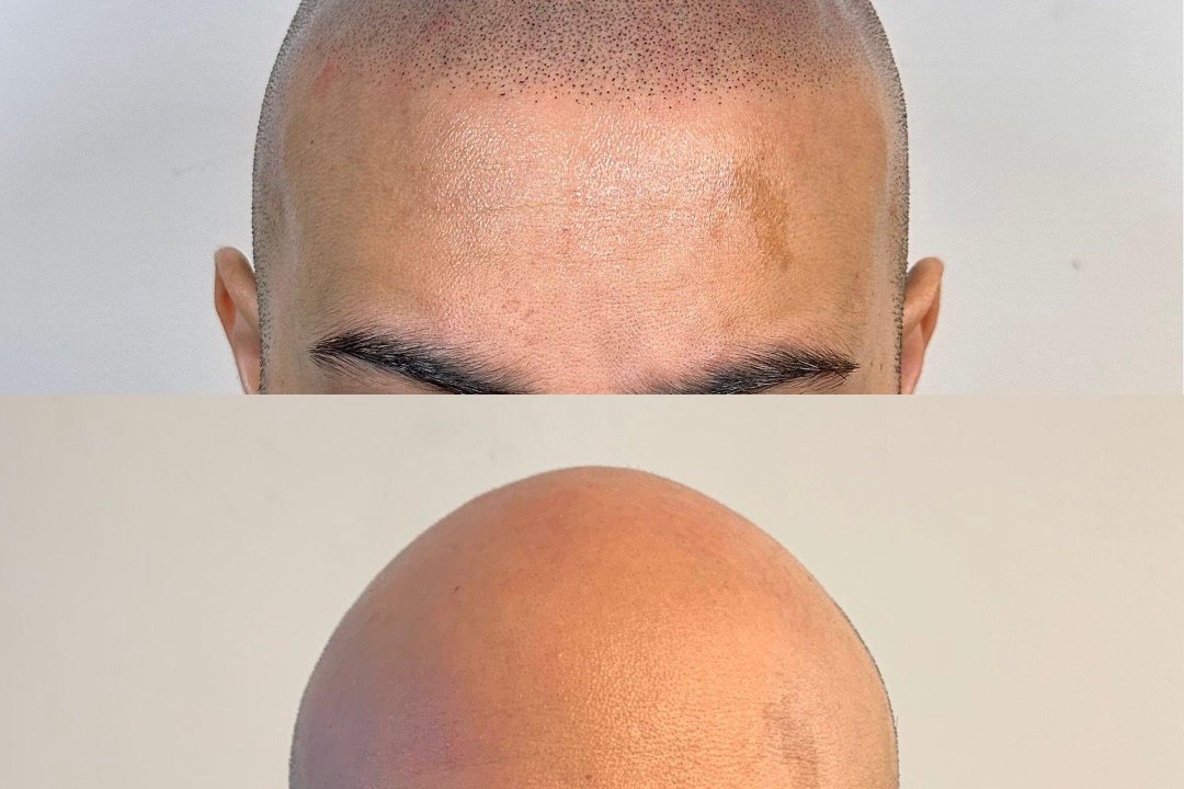 Ink Heads SMP Hair Tattoo London, Cambridge Heath, London