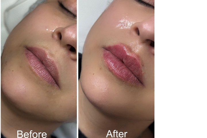 Allure Hair, Skin & Laser Treatment - Soin visage Moortown - Photo de galerie - OneBooking