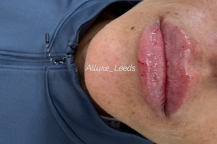 Allure Hair, Skin & Laser Treatment - Soin visage Moortown - Photo de galerie - OneBooking