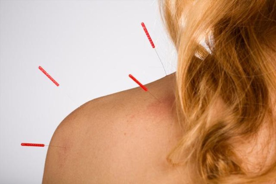 Rise Acupuncture, Cheltenham, Gloucestershire