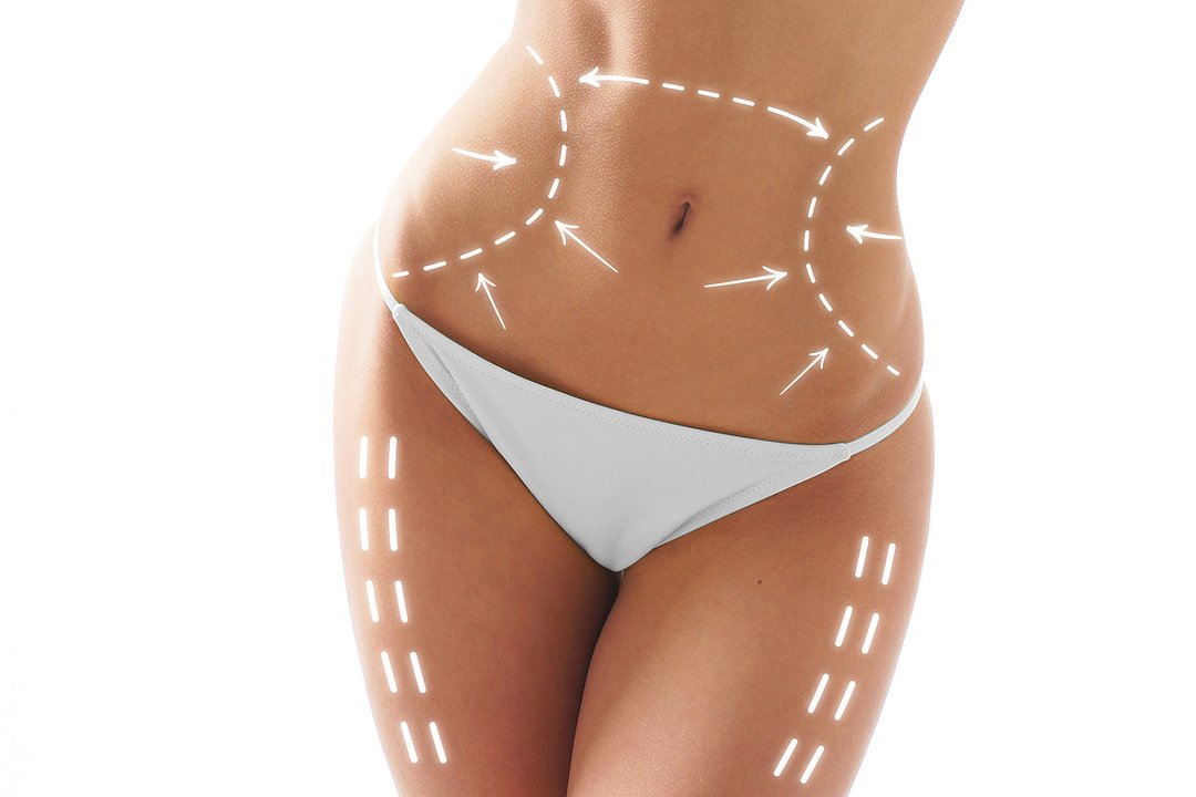 Fat Freezing Cryolipolysis, Kew, London